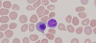 Dacryocytes, or teardrop-shaped cells, are found in myelofibrosis and myelophthisic states of bone marrow. Mississauga's YM Bioscience's Myelofibrosis treatment, CYT387, has performed well in Phase Two trials. Byron Capital Healthcare analyst Douglas Loe thinks this may soon attract a larger 