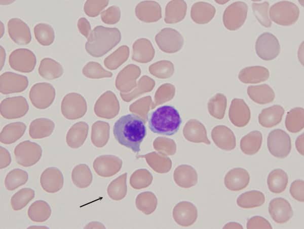 Dacryocytes, or teardrop-shaped cells, are found in myelofibrosis and myelophthisic states of bone marrow. Mississauga's YM Bioscience's Myelofibrosis treatment, CYT387, has performed well in Phase Two trials. Byron Capital Healthcare analyst Douglas Loe thinks this may soon attract a larger 
