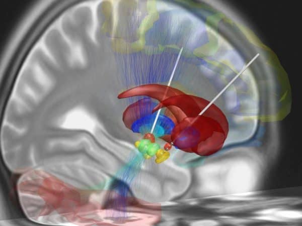 deep brain stimulation.