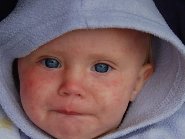 Measles on the rise